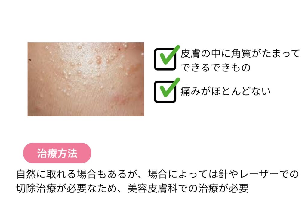 稗粒腫（角質のかたまり）