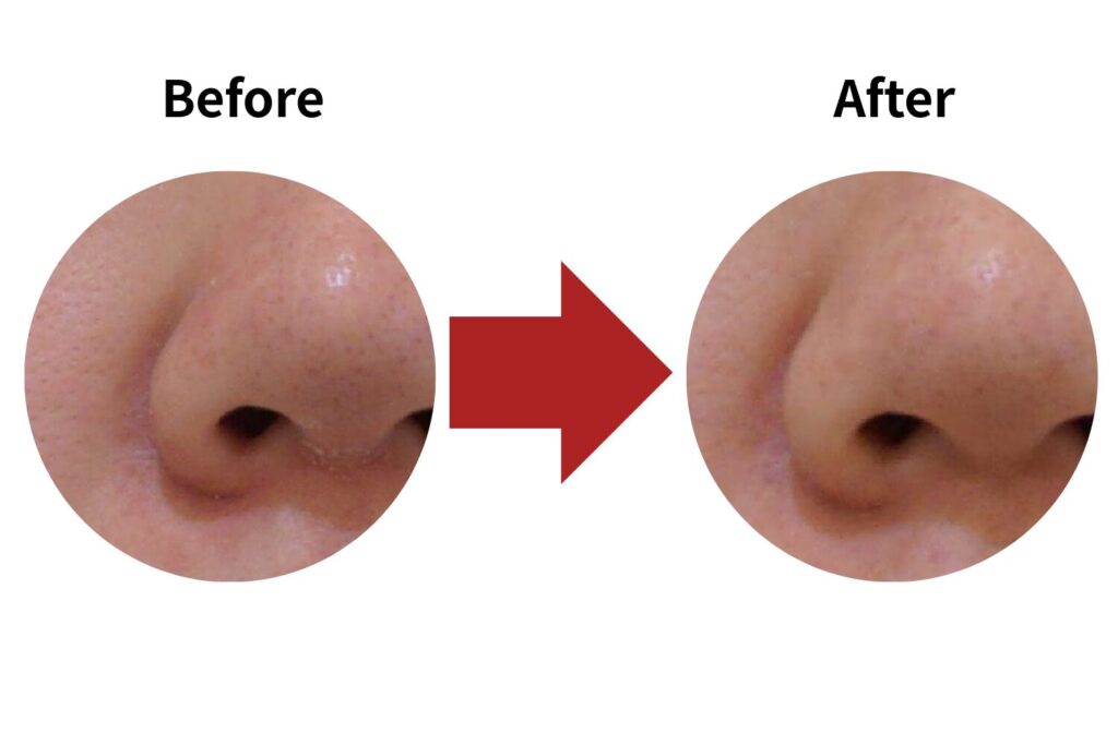 毛穴の開きの改善