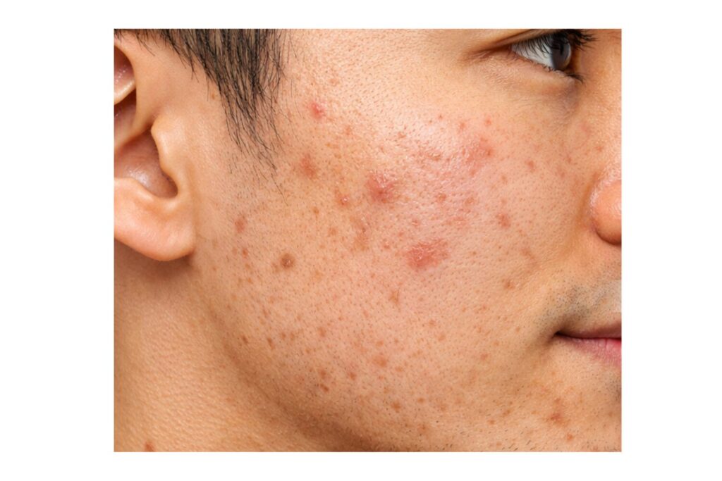 自力で改善しやすいニキビ跡