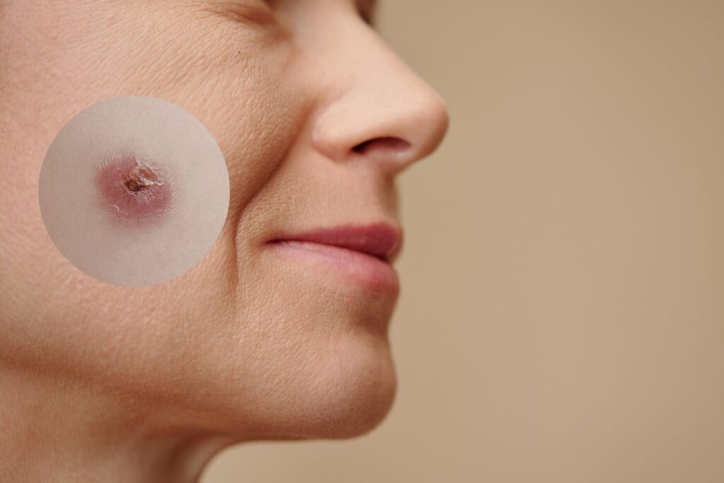 シミ取り後のかさぶたはいつ取れる?経過・日数・注意点を解説