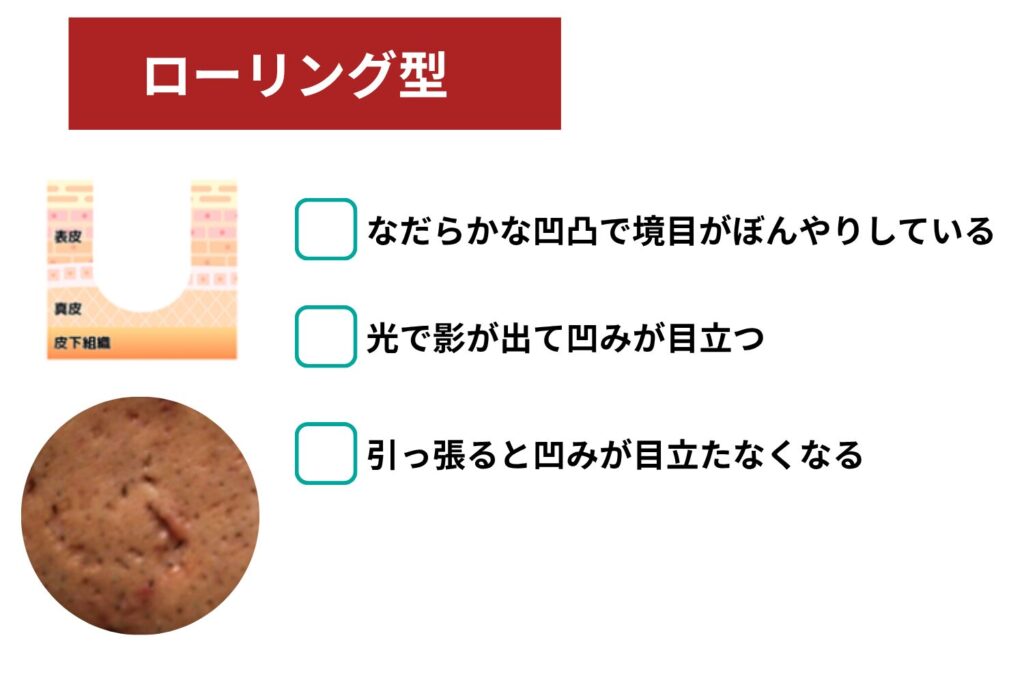 ローリング型クレーター
