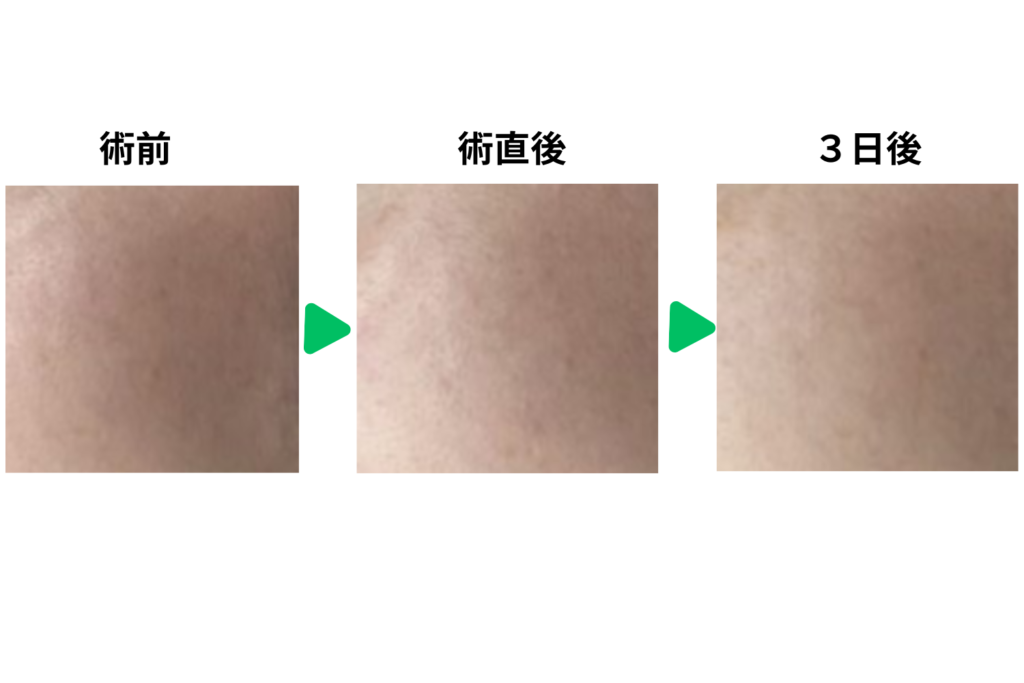 施術直後〜当日の症状