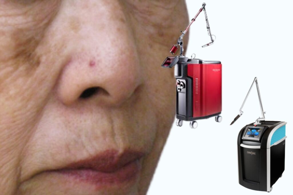 ピコレーザーとQスイッチはどっちがいい？違い・選び方を徹底比...