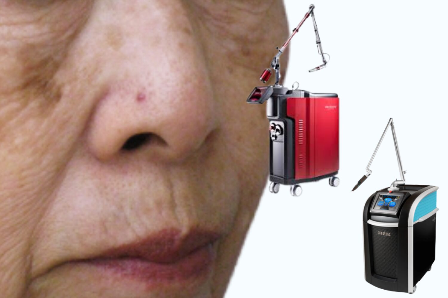 ピコレーザーとQスイッチはどっちがいい？違い・選び方を徹底比較