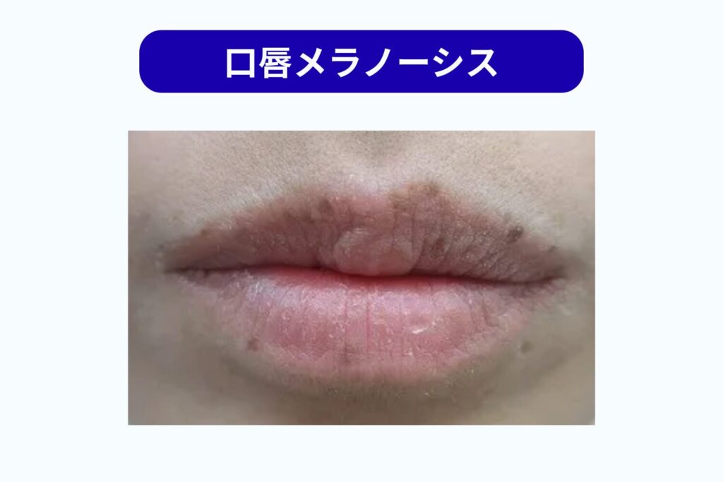 口唇メラノーシス