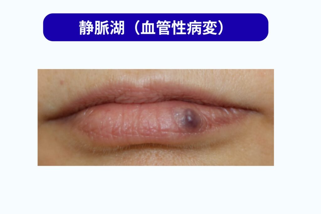 静脈湖（血管性病変）