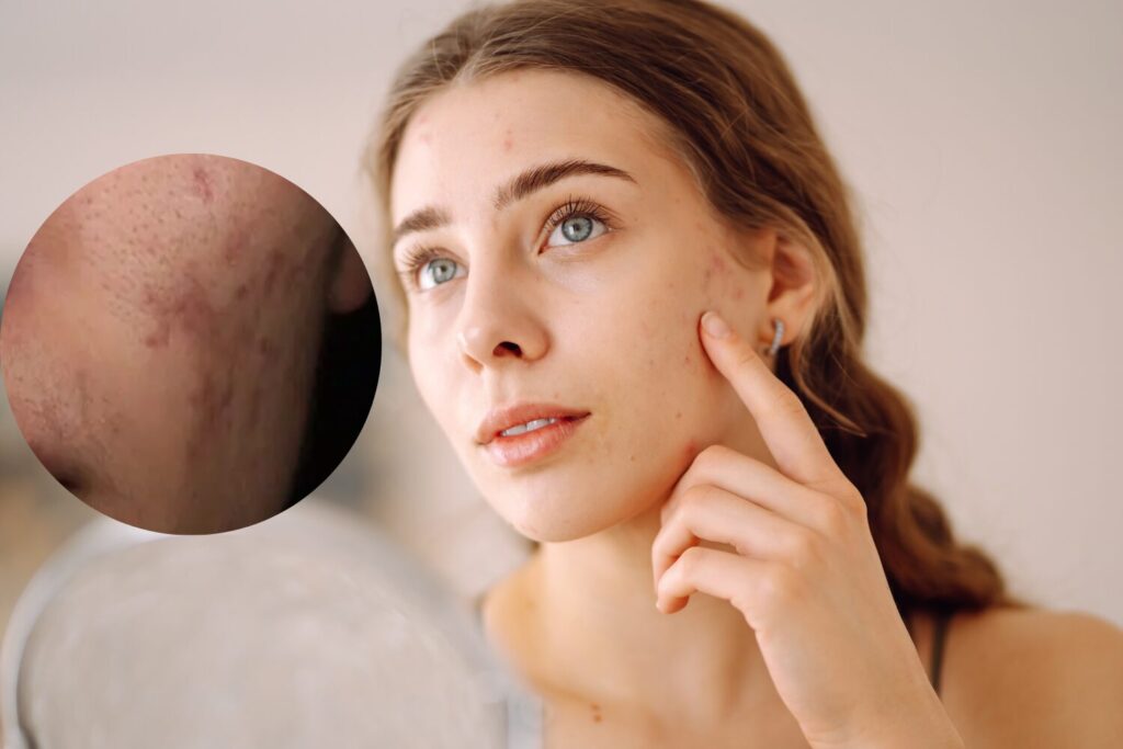 ニキビ跡が茶色になる原因とは？治るまでの期間と消す方法