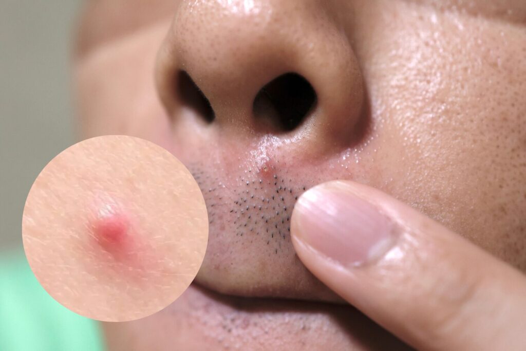 ニキビ鼻の下の原因と治し方｜悪化させない対処法