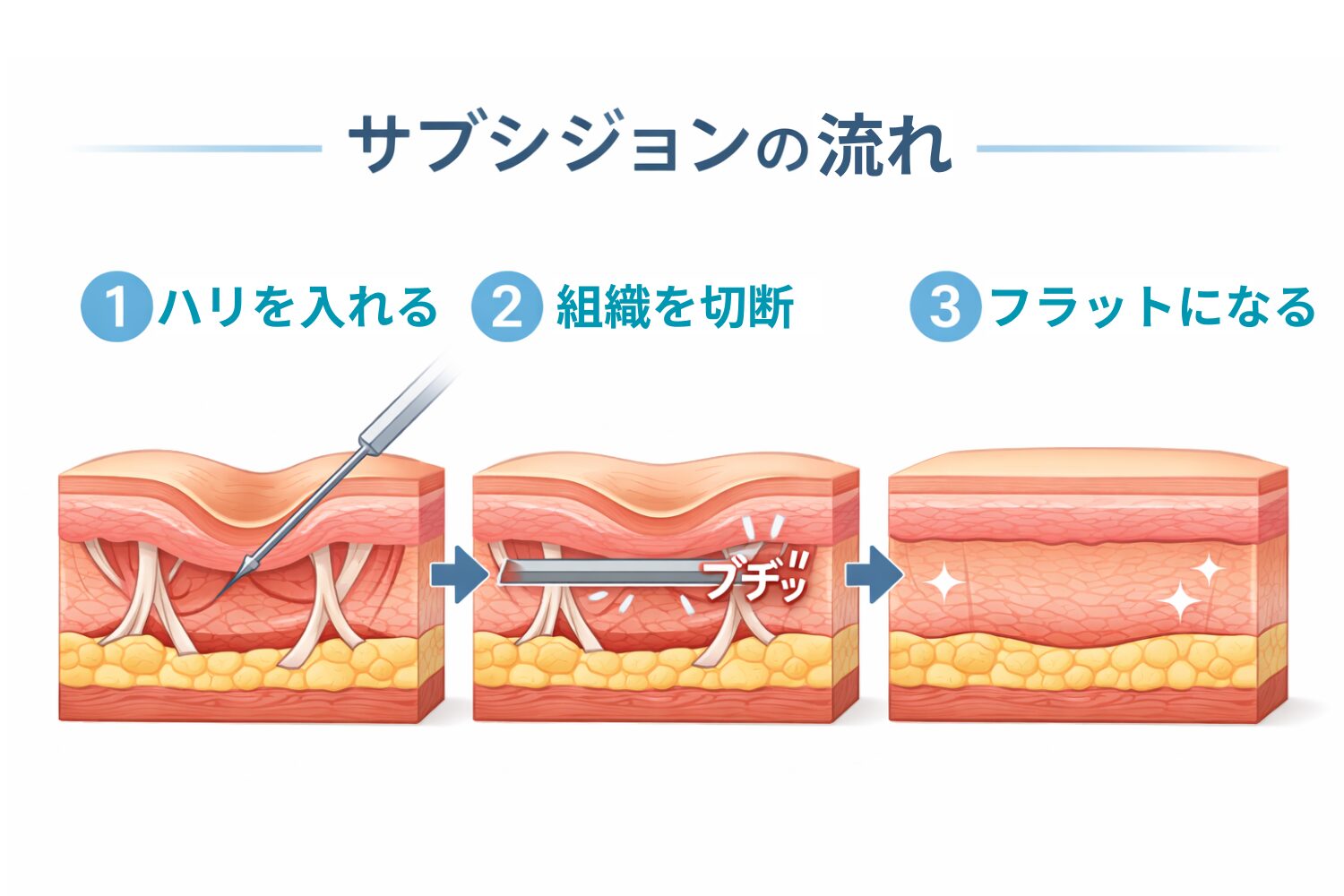 サブシジョンの施術方法