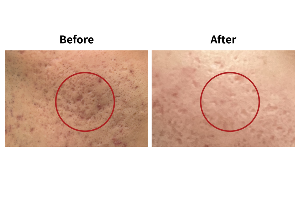 サブシジョンの効果