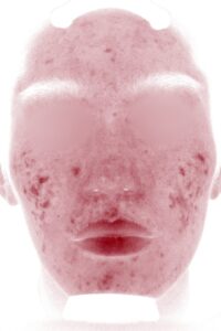 ニキビビフォー