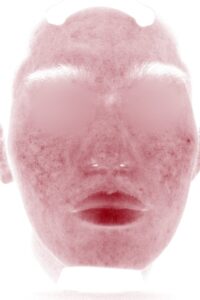 ニキビアフター