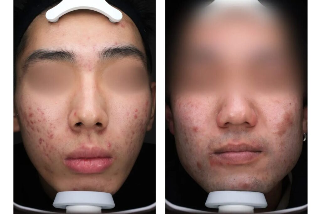 メンズのニキビ跡を消したい!自宅ケアと治療法まとめ