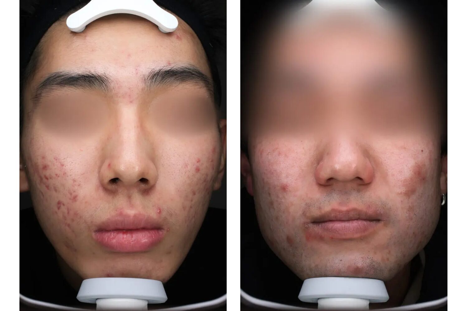 メンズのニキビ跡を消したい!自宅ケアと治療法まとめ