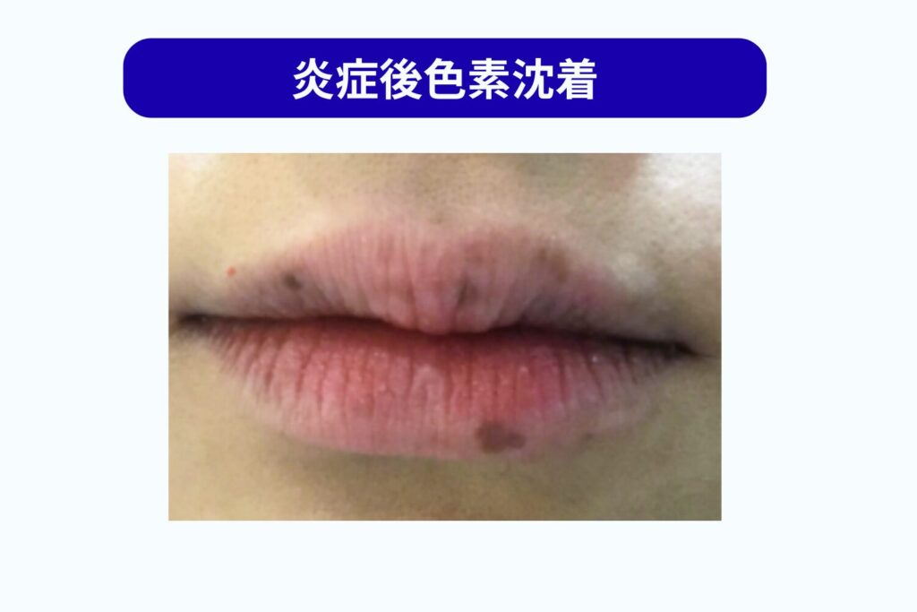 炎症後色素沈着