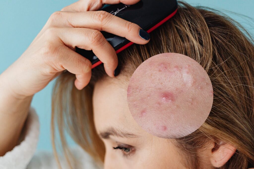 頭皮ニキビはなぜできる？原因・セルフケア・治療方法を解説