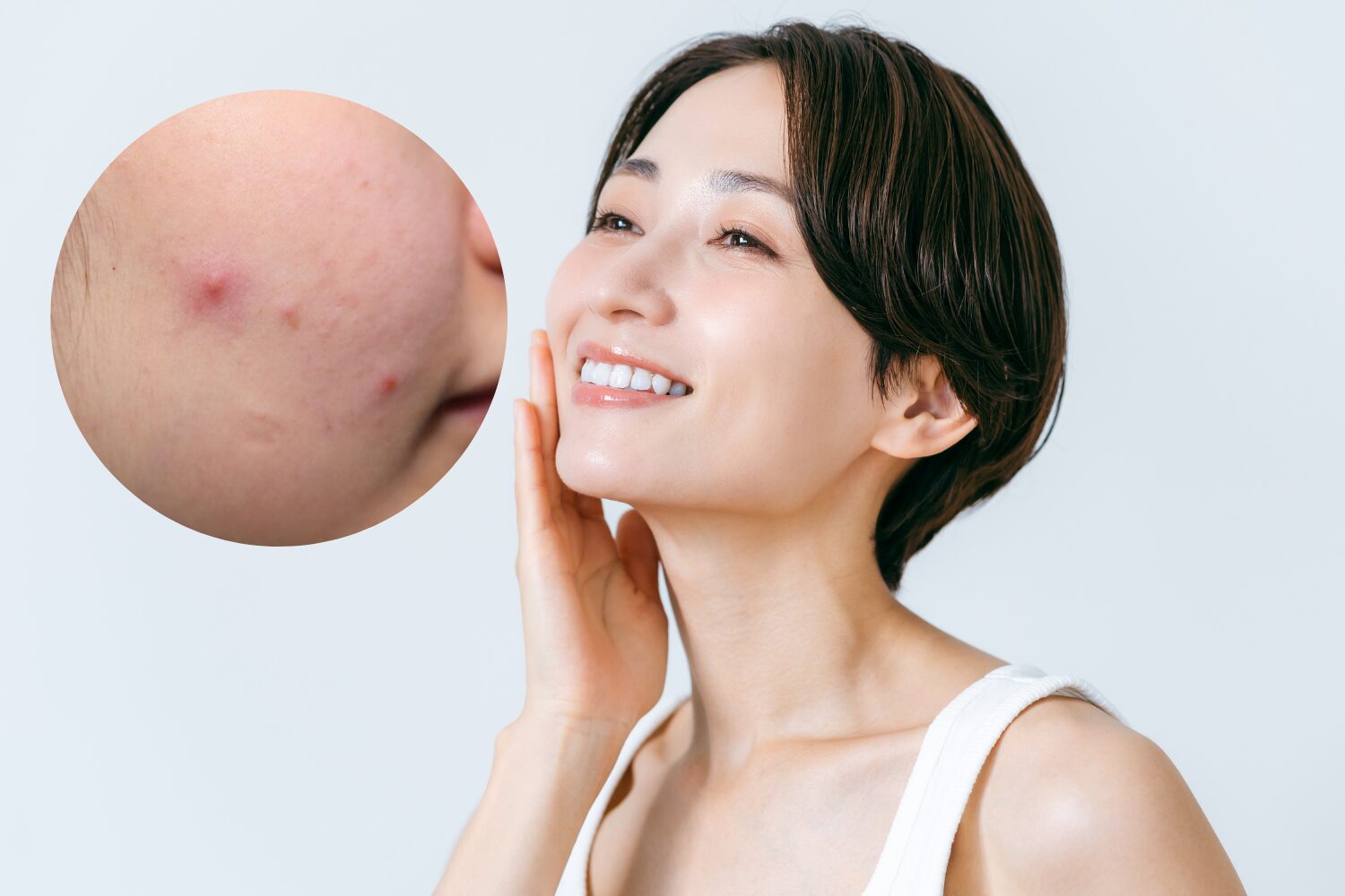 40代で大人ニキビができる原因と治し方