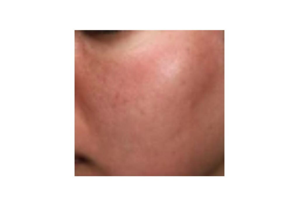 施術直後：赤みが出やすい