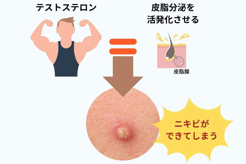 テストステロンでニキビが増える仕組み
