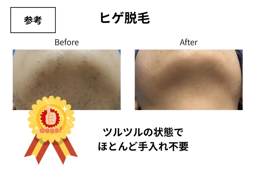 8回〜10回は自己処理がほとんど不要