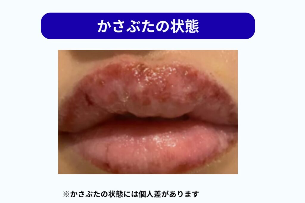 施術直後〜数日の変化