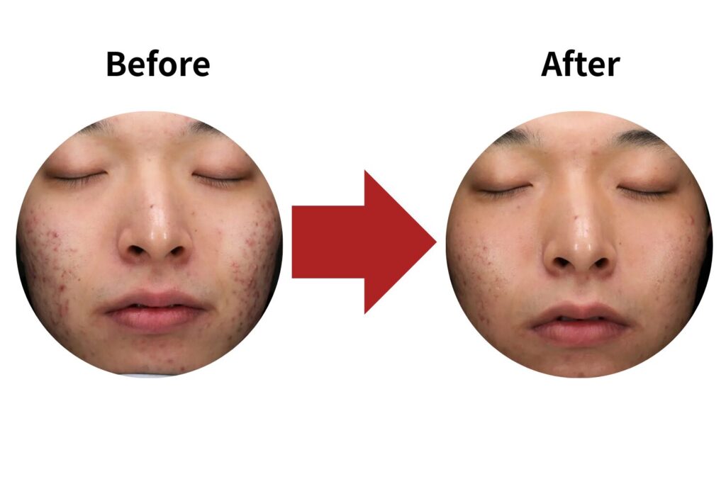 ニキビ跡の改善