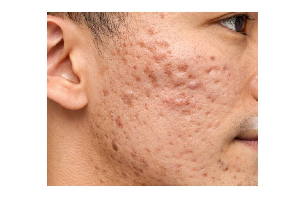 自力では治しにくいニキビ跡