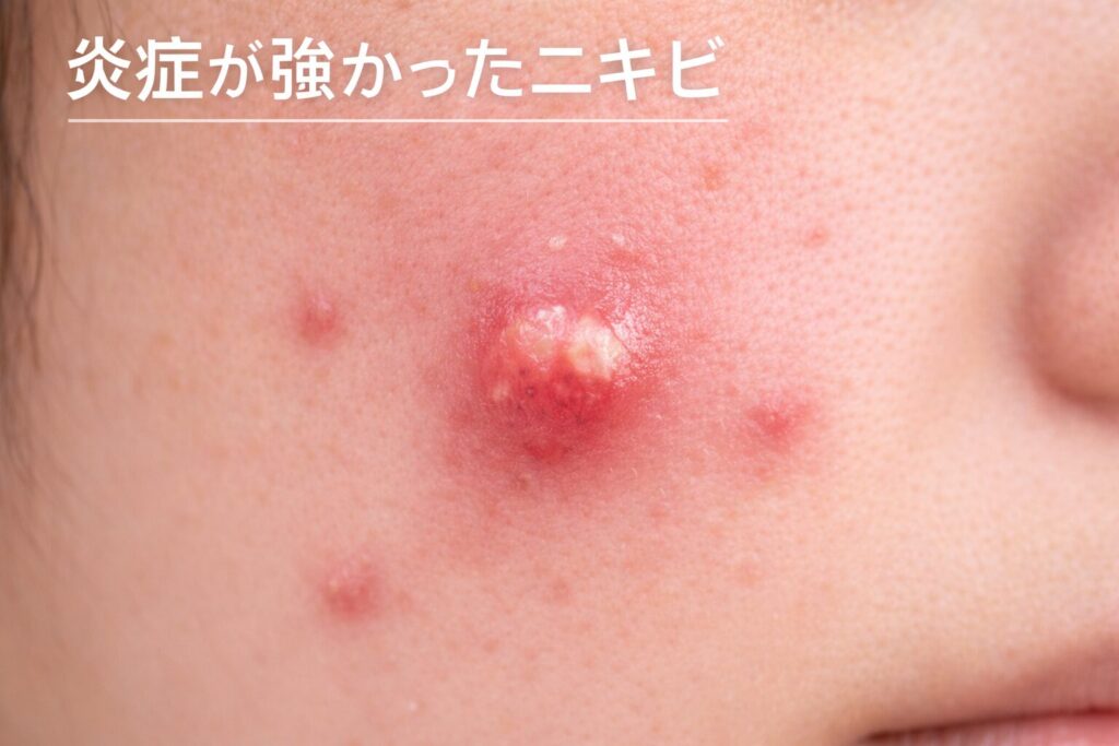 炎症が強いと長期間残ることがある