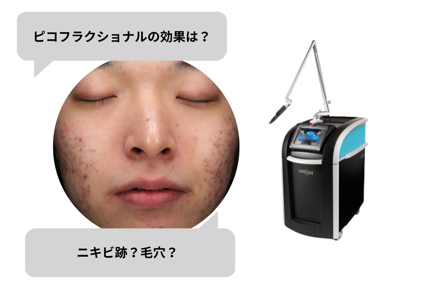 ピコフラクショナルの効果とは？ニキビ跡・毛穴改善や回数の目安を解説