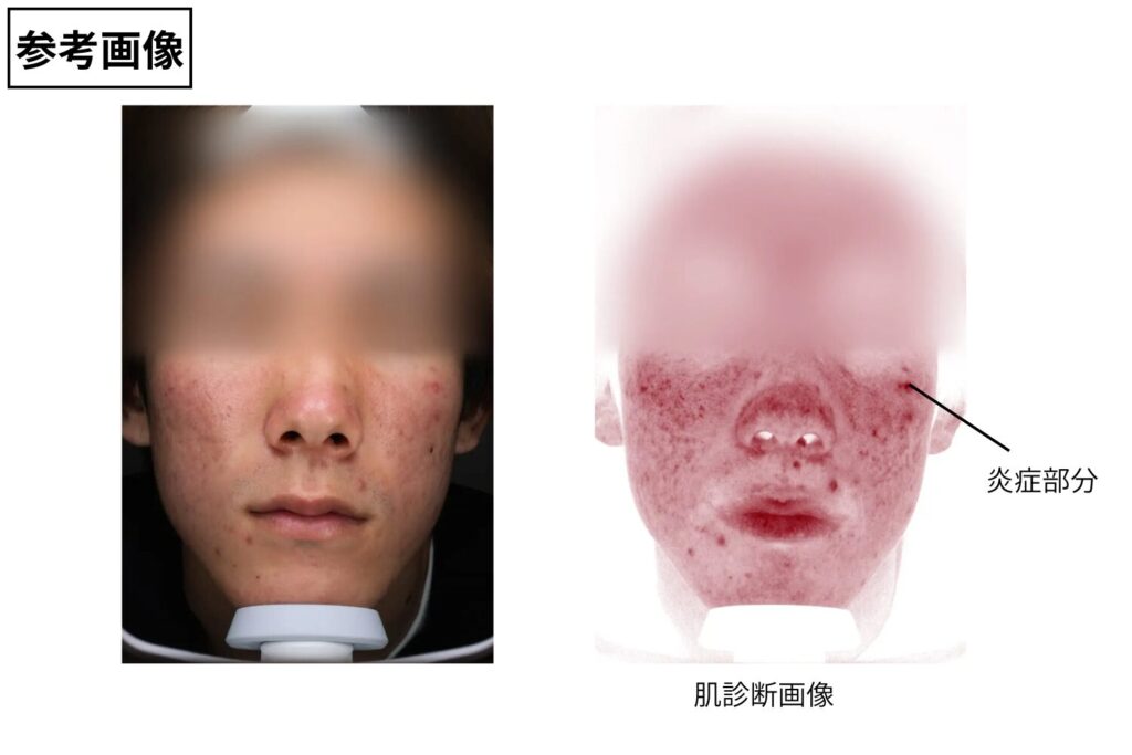 赤みや色素沈着が残ることがある