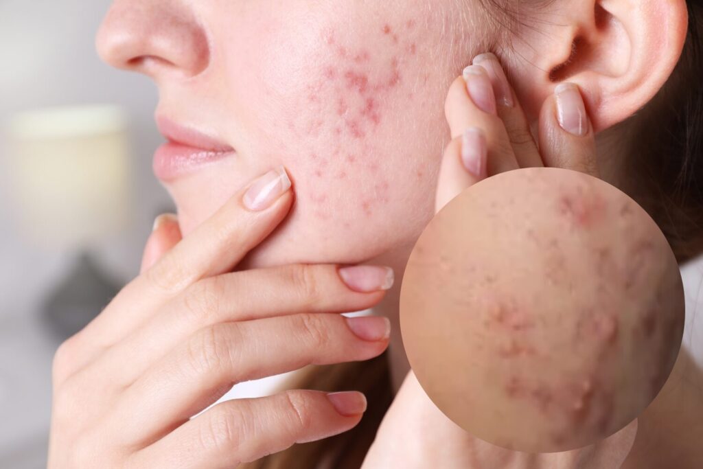 ニキビ跡の赤みの原因と治し方｜自然に治る？対策と治療法