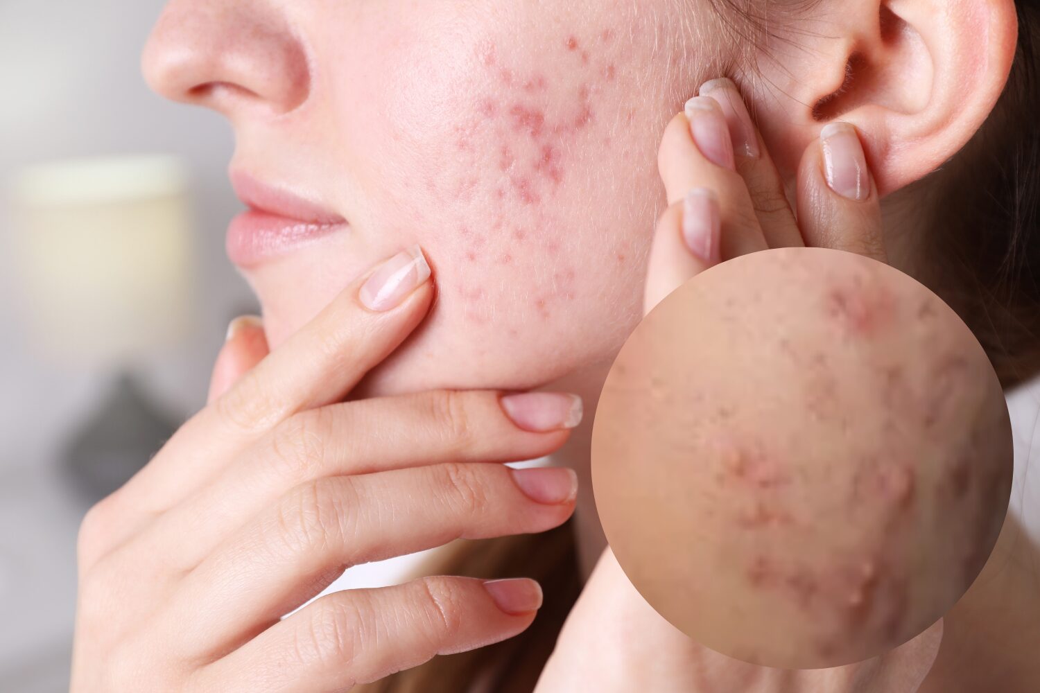 ニキビ跡の赤みの原因と治し方|自然に治る?対策と治療法