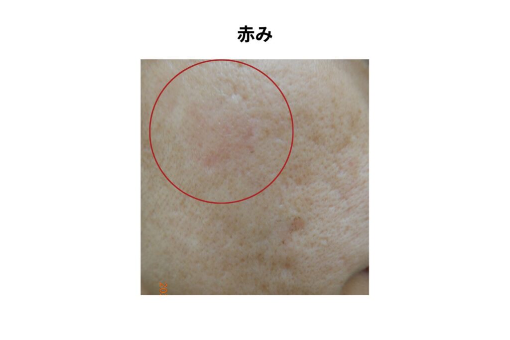 赤みが残る場合