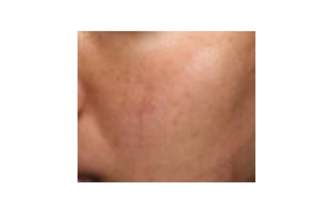 翌日〜2日：赤みが徐々に落ち着く