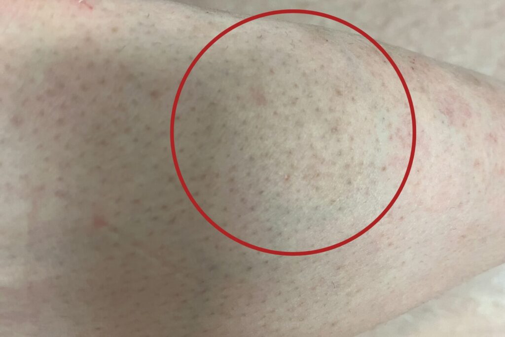 脱毛後に毛穴の赤みやブツブツが出る原因