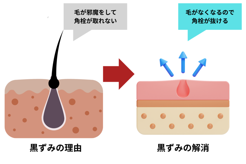 脱毛で改善しやすい黒ずみ