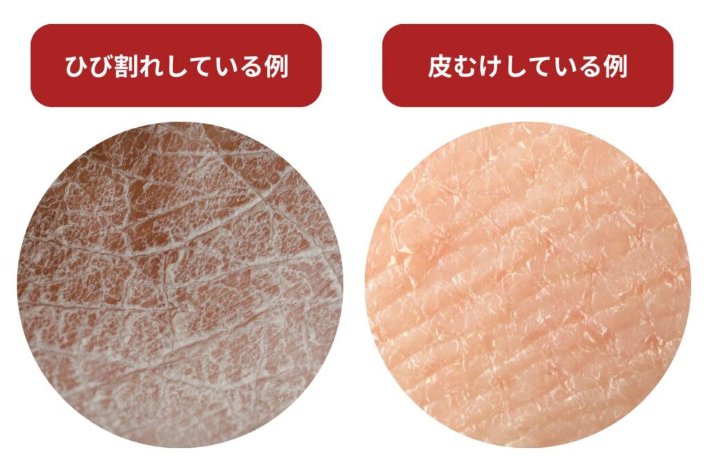 乾燥肌や敏感肌は状態次第で施術できる