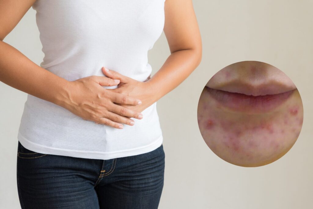 生理前にニキビが増える理由とケア方法