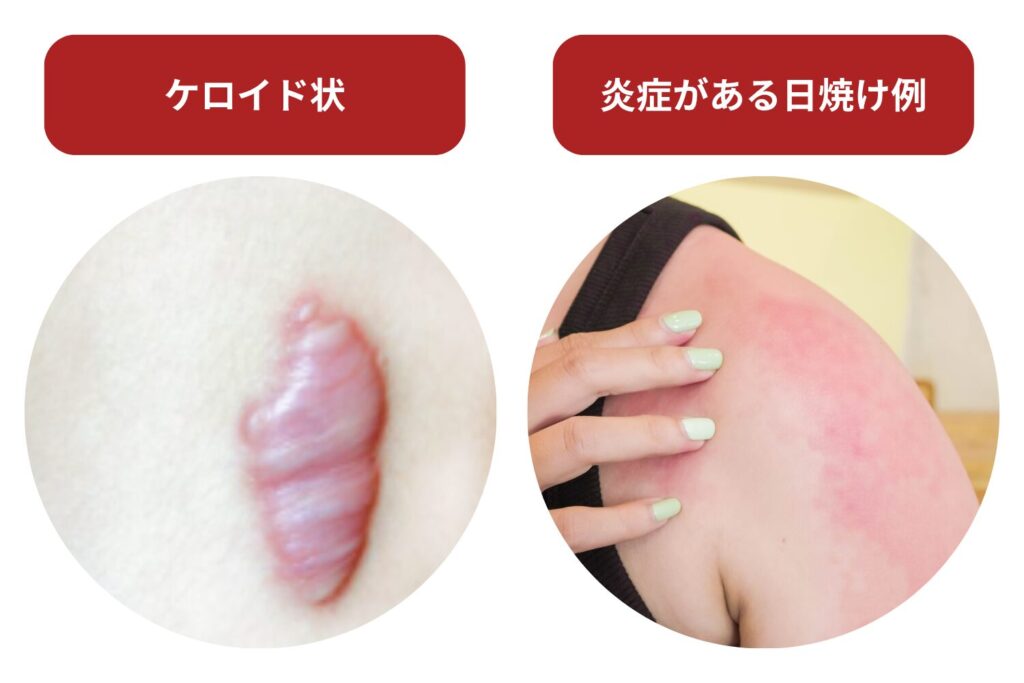 炎症や傷がある部位は照射を避ける