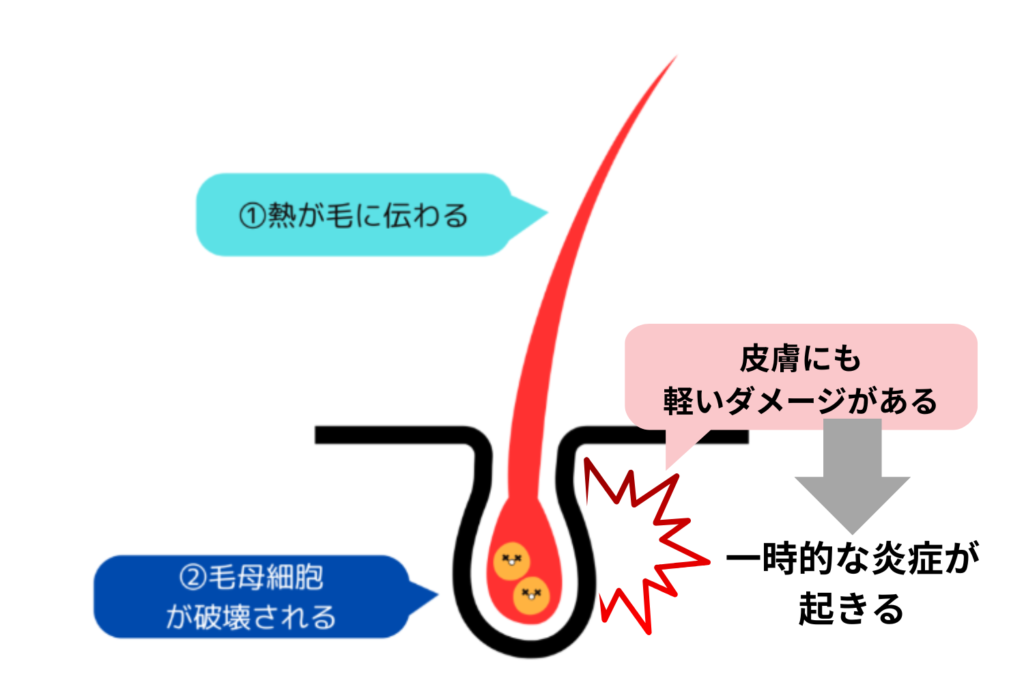 毛穴の赤みの原因