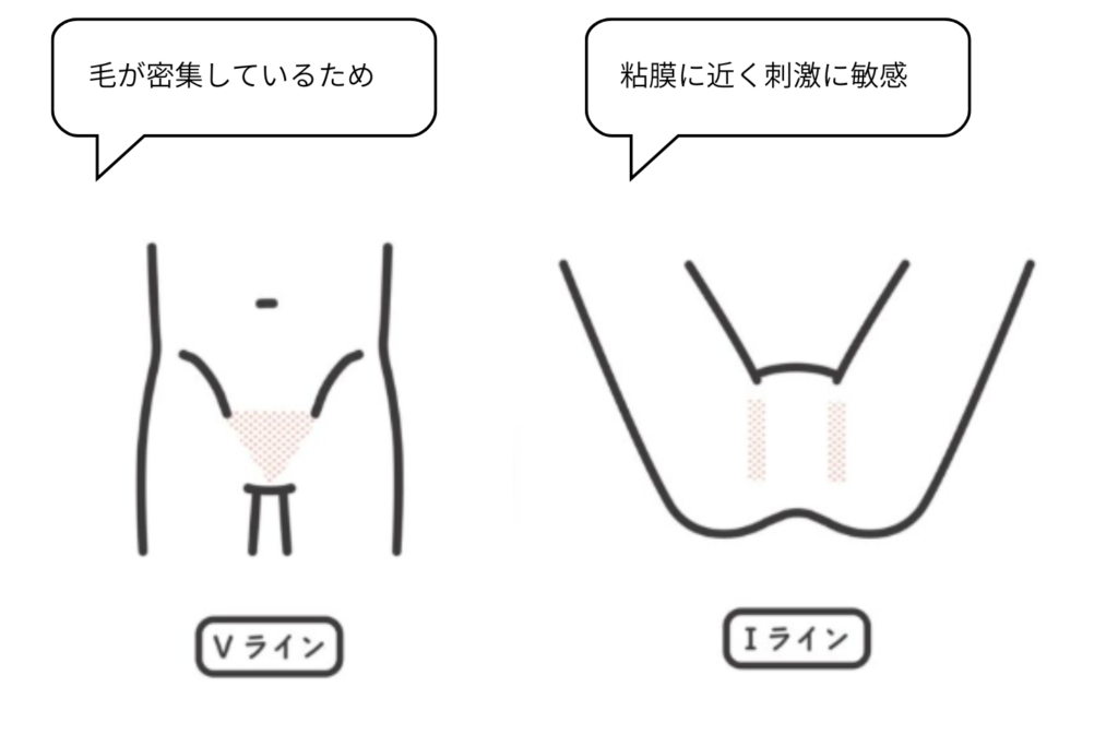 VIOで痛みが出やすい部位