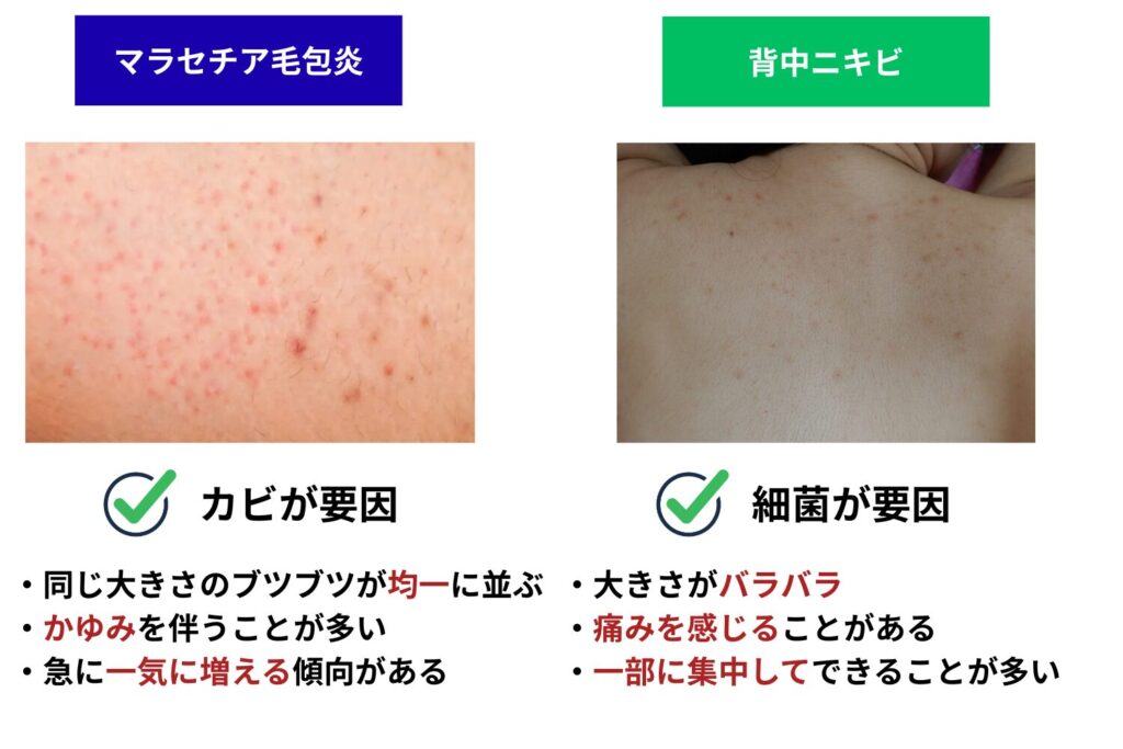 マラセチア毛包炎はニキビと見た目が似ている