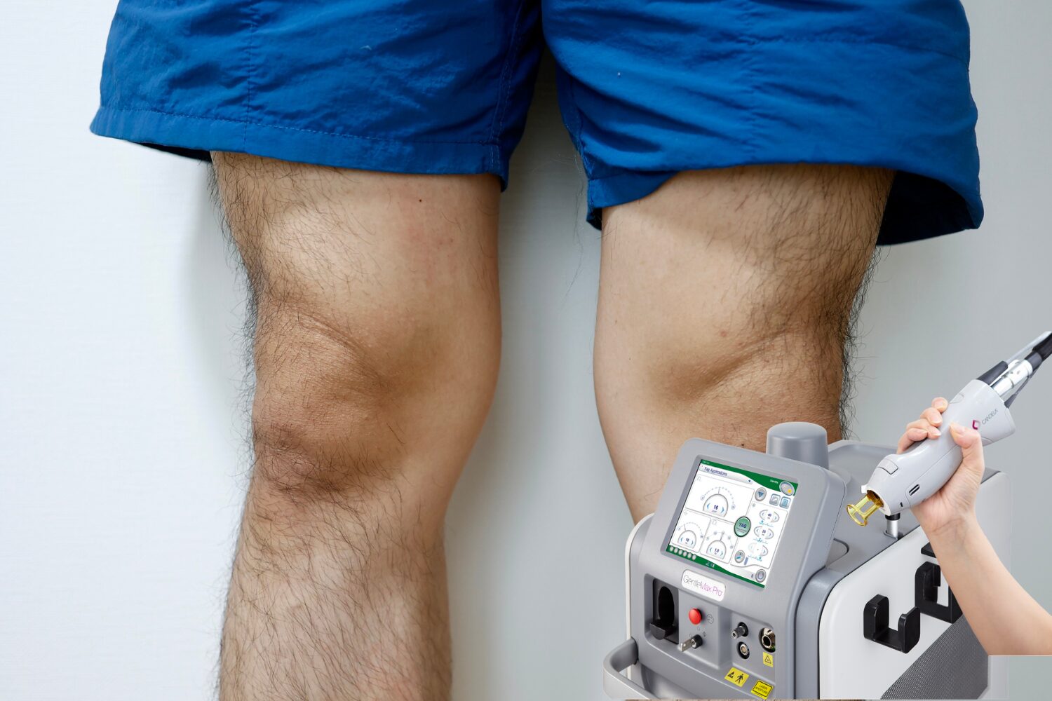 メンズのすね毛脱毛ガイド｜回数・費用・痛みを解説