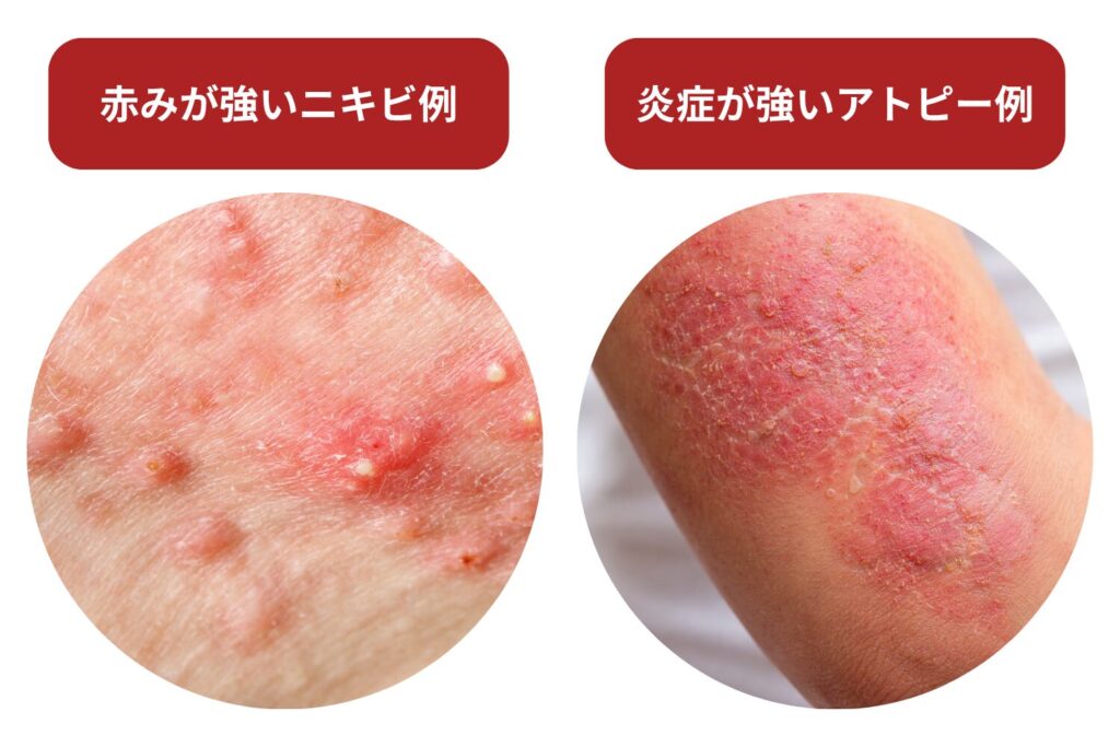 アトピーやニキビは医師の判断が必要