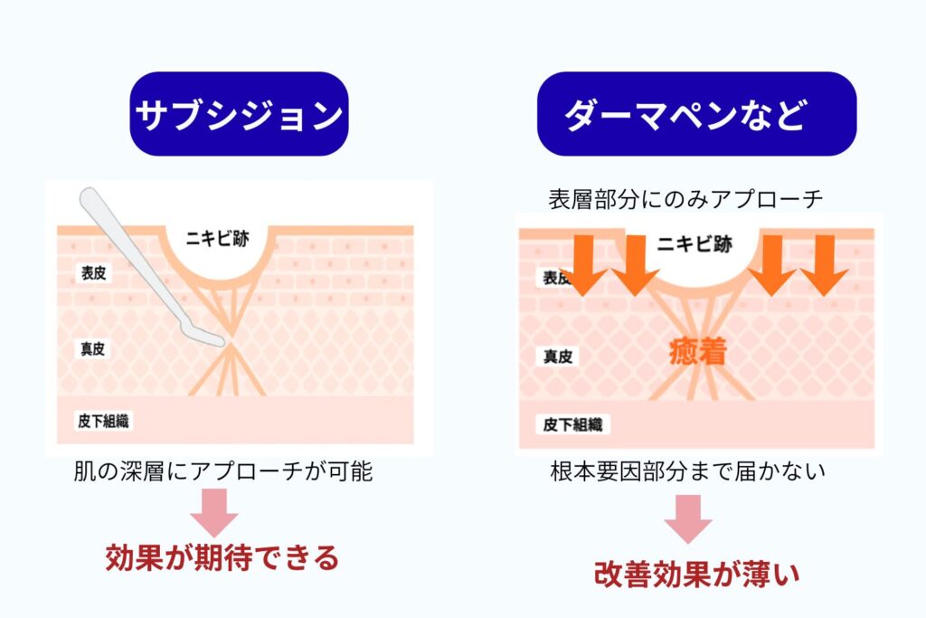 ダーマペン・レーザーではなくサブシジョンが必要なケース