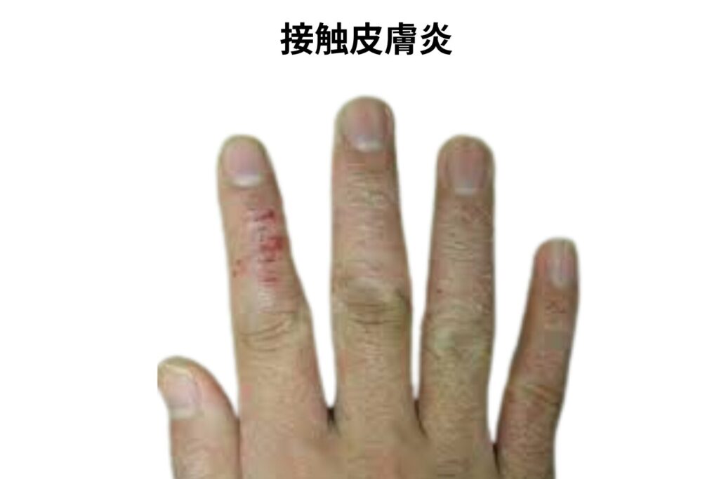 接触皮膚炎