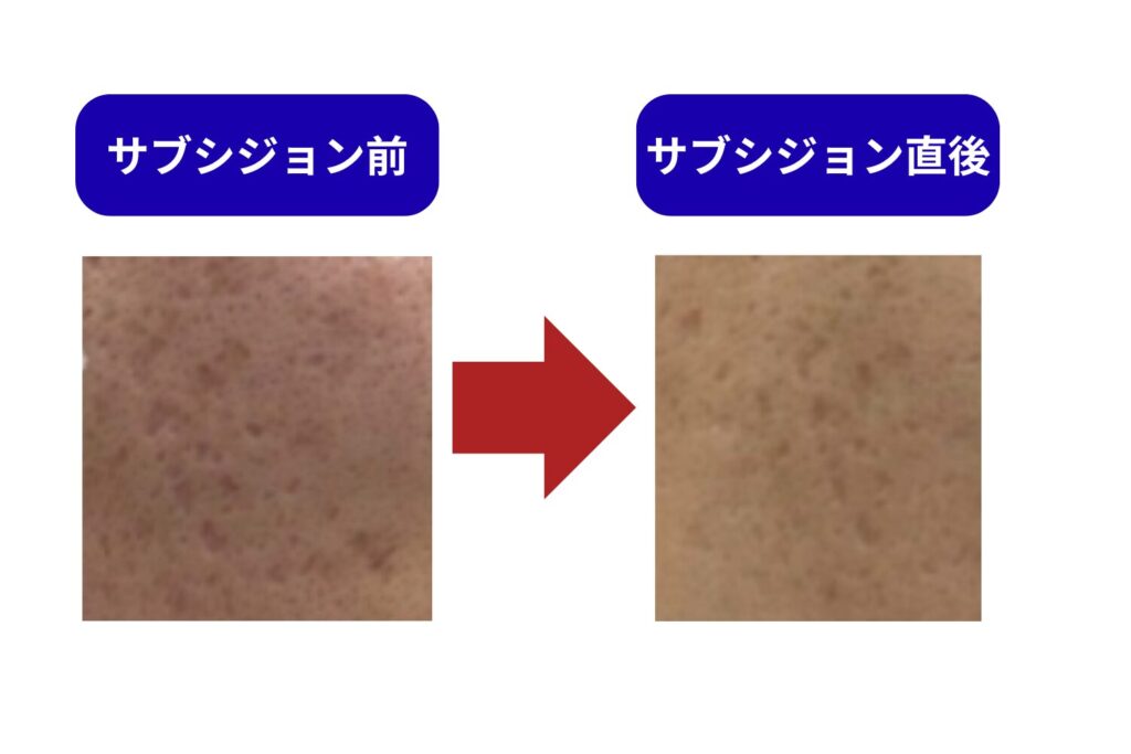 腫れ・内出血はどのくらい続くの？