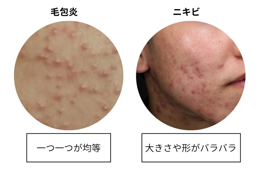 ブツブツの大きさや出方を確認する