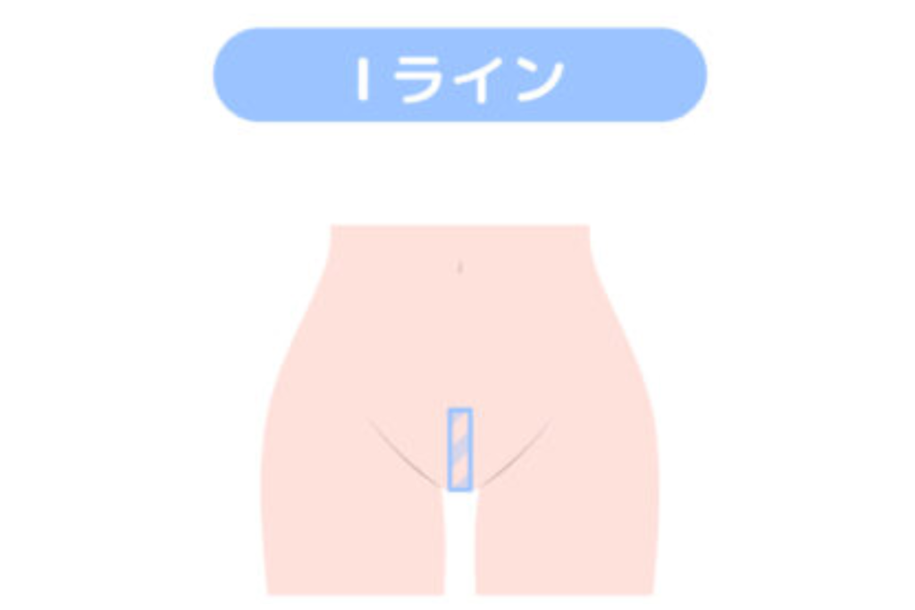 Iライン型は毛量をかなり減らしたい方に人気