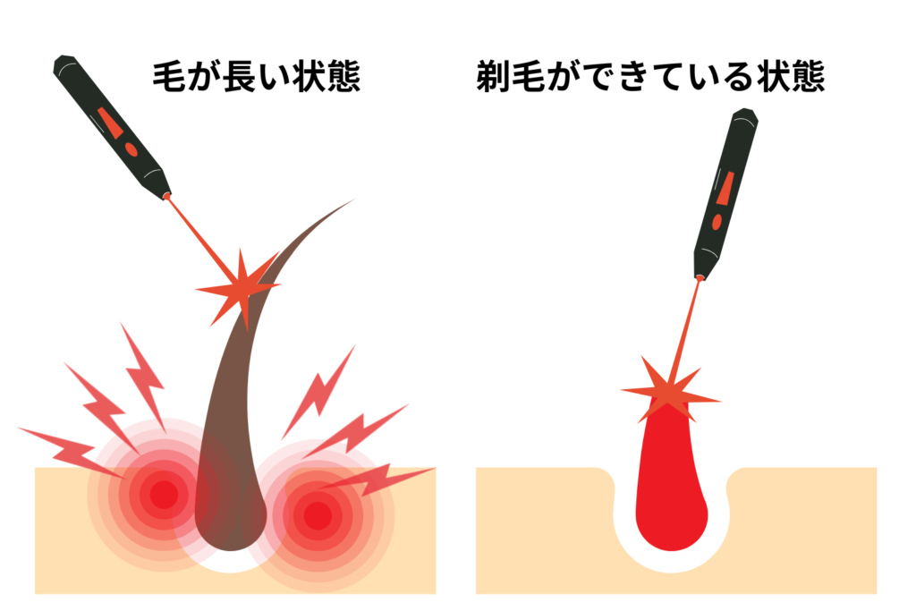 剃り残しはやけどや赤みの原因になる